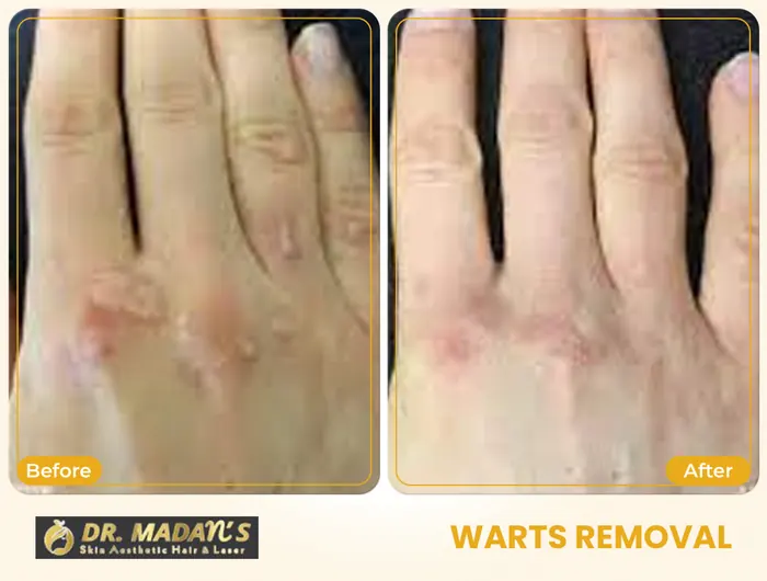 Warts removal before and after result 3 at Dr Madan Aesthetics
